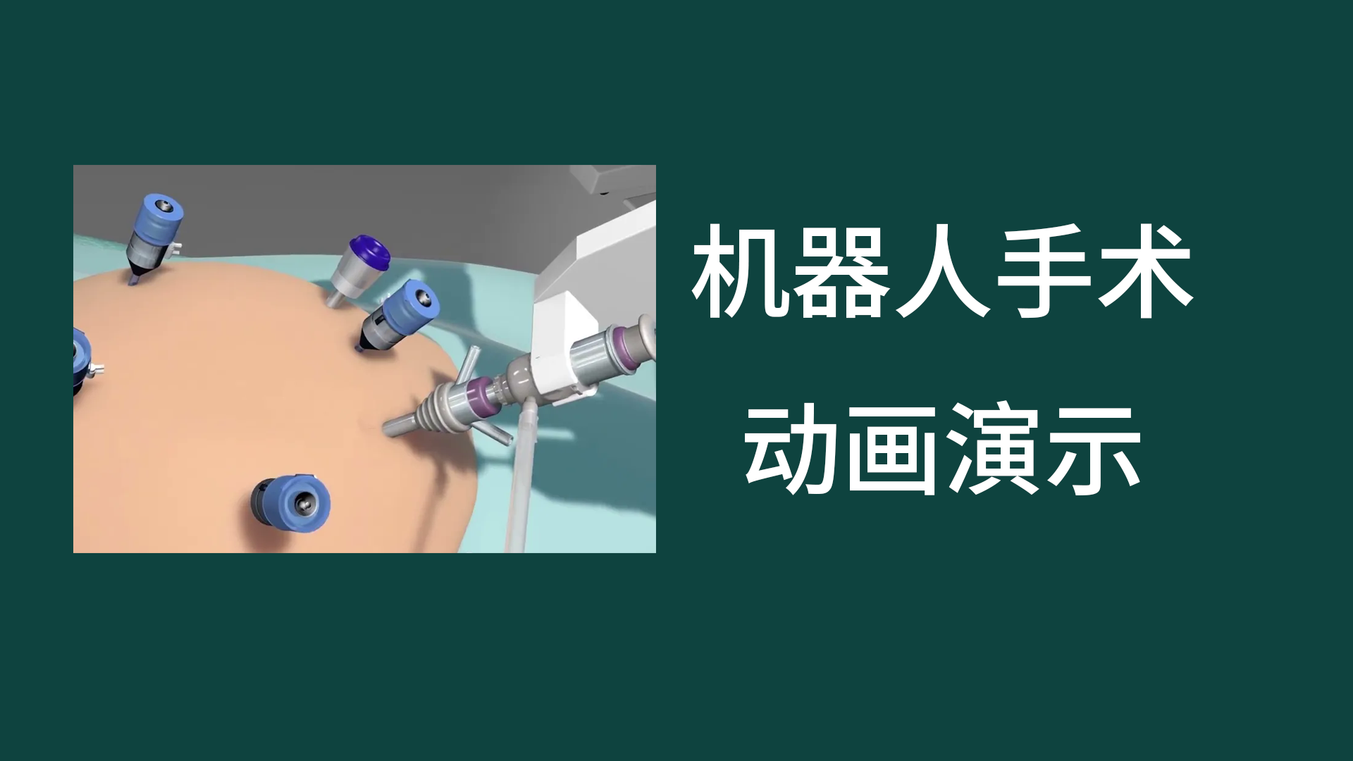 机器人减肥手术