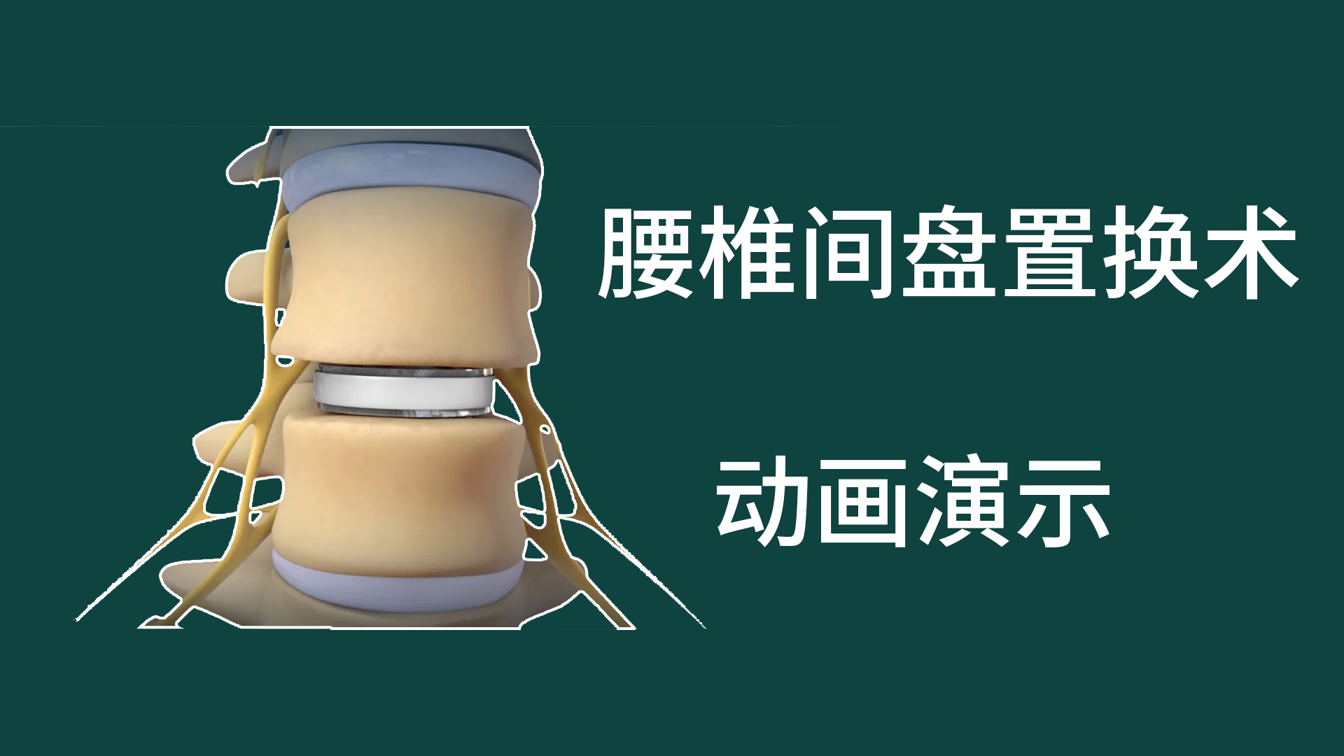 腰椎间盘置换术