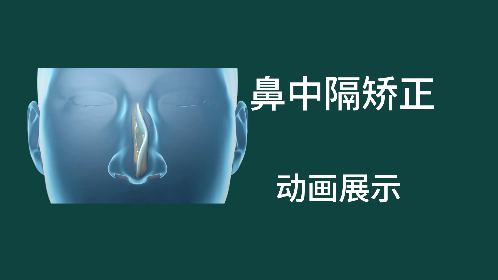 鼻中隔偏曲矫正手术