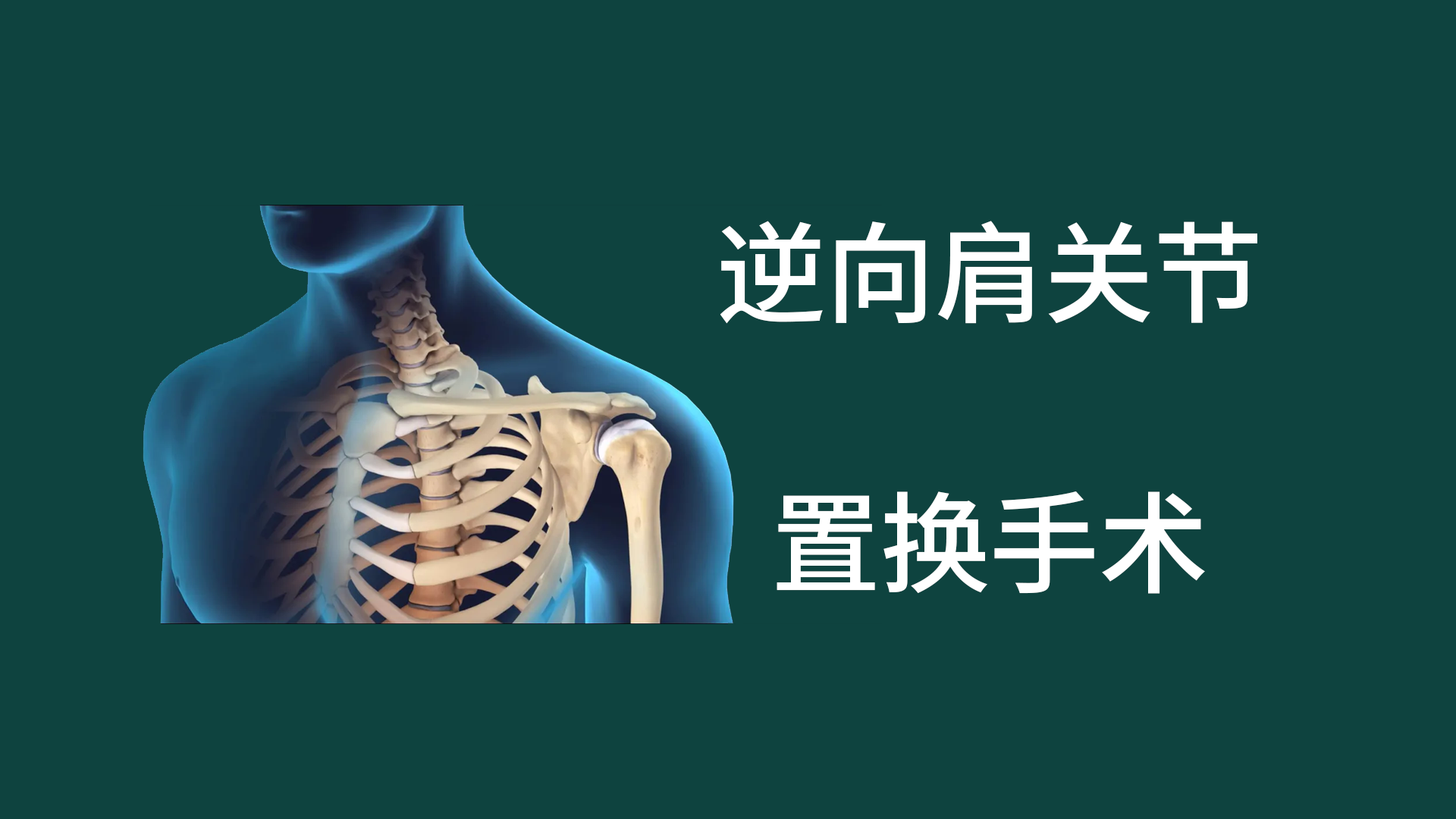 逆向肩关节置换手术